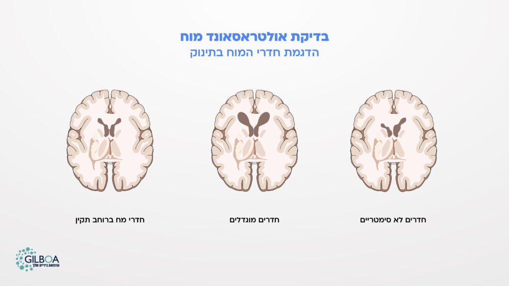 אולטרסאונד מוח לתינוק - חדרי מוח